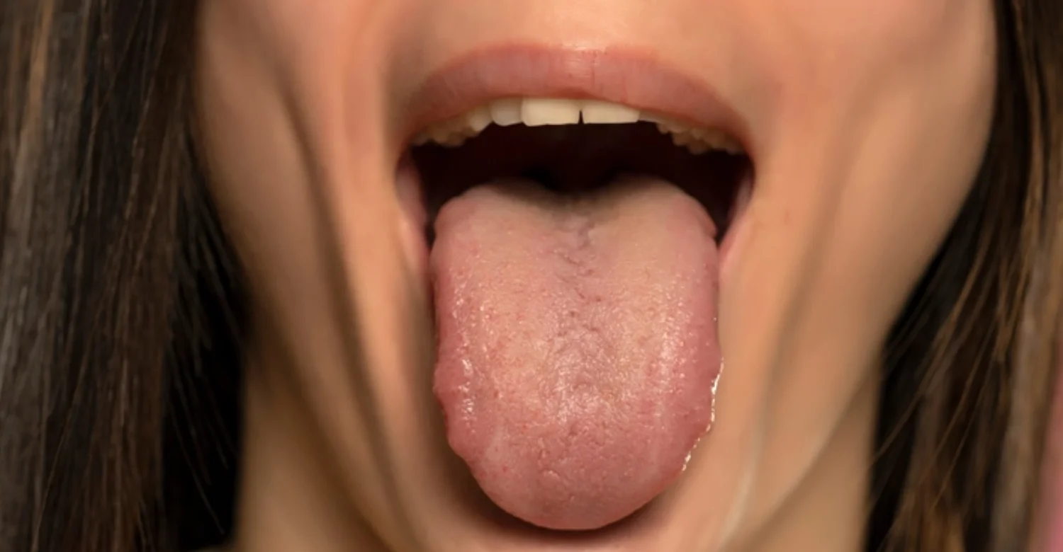 Scalloped Tongue inblog